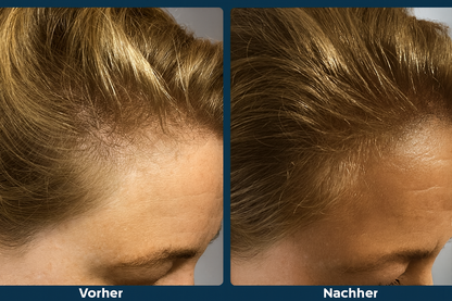 HaarWuchs Bürste - für volles Haar